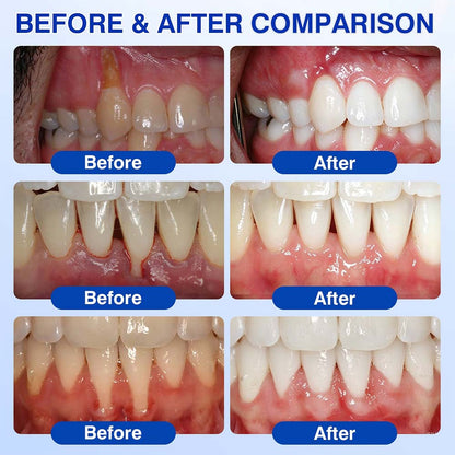 Healrize® GumRevive gel for the regeneration of the tooth-supporting apparatus (for bleeding gums, receding gums, and loose teeth) 🪥🦷1