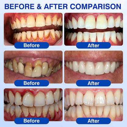 Healrize® GumRevive gel for the regeneration of the tooth-supporting apparatus (for bleeding gums, receding gums, and loose teeth) 🪥🦷1