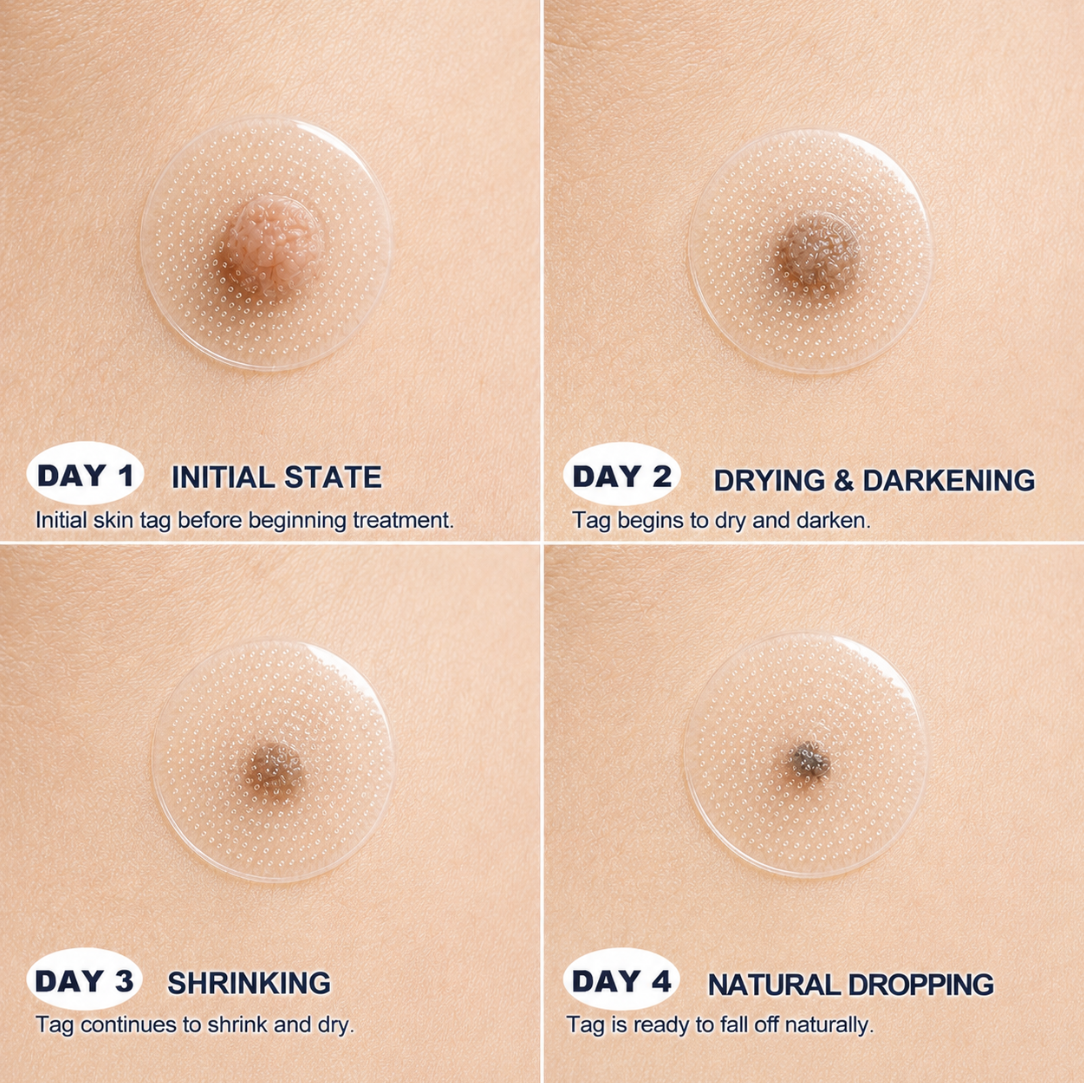 ☘️ 𝐎𝐟𝐟𝐢𝐜𝐢𝐚𝐥 𝐒𝐭𝐨𝐫𝐞 | H𝐞a𝐥r𝐢z𝐞®  ☘️𝐁𝐨𝐭𝐚𝐧𝐢𝐜𝐚𝐥 𝐌𝐢𝐜𝐫𝐨𝐧𝐞𝐞𝐝𝐥𝐞 𝐇𝐲𝐝𝐫𝐨𝐜𝐨𝐥𝐥𝐨𝐢𝐝 𝐏𝐚𝐭𝐜𝐡 (𝐅𝐨𝐫 𝐒𝐤𝐢𝐧 𝐓𝐚𝐠𝐬, 𝐒𝐦𝐚𝐥𝐥 𝐒𝐤𝐢𝐧 𝐆𝐫𝐨𝐰𝐭𝐡𝐬, 𝐖𝐚𝐫𝐭𝐬, 𝐌𝐨𝐥𝐞𝐬, 𝐀𝐠𝐞 𝐒𝐩𝐨𝐭𝐬 & 𝐏𝐢𝐠𝐦𝐞𝐧𝐭𝐚𝐭𝐢𝐨𝐧 𝐂𝐨𝐧𝐜𝐞𝐫𝐧𝐬)🎉🎉